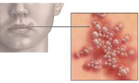 Hình ảnh bệnh herpes sinh dục ở miệng