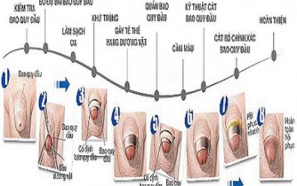 Ưu điểm phương pháp cắt bao quy đầu bằng công nghệ