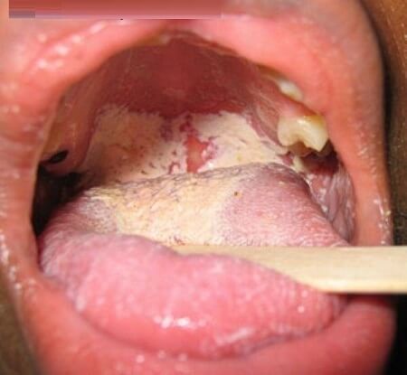 Hình ảnh về bệnh lậu ở nam giới: Hình ảnh bệnh lậu ở miệng